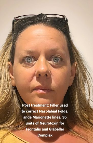 After, improved facial volume, Neurotoxin & Dermal filler, youthful appearance Harrisburg PA Med Spa