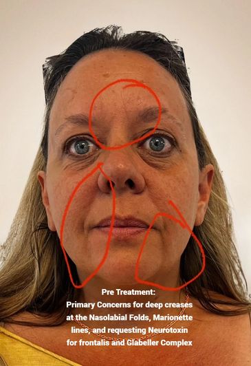 Treatmenting "Angry 11's", and deep wrinkles with Tox and Dermal Filler or Hyaluronic Acid filler
