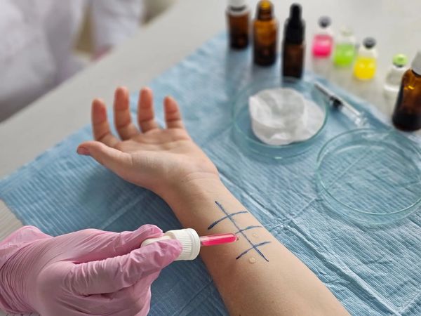Specialist performing an allergy skin prick test.