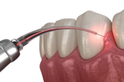 Laser dental treatment in crossings republik 