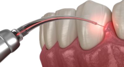 Laser dental treatment-crossings Republik-first impressions dental and implant clinic