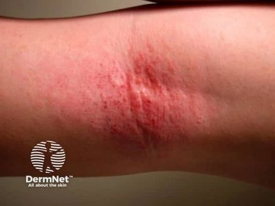 Atopic dermatitis in the crook of someone's elbow