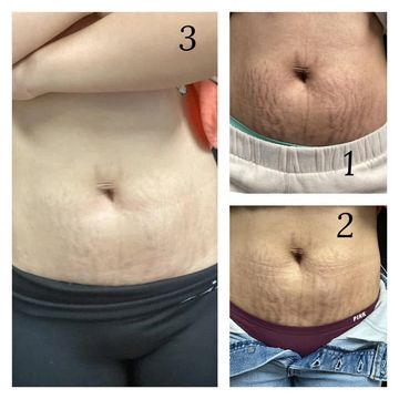Inkless Stretchmark Revision