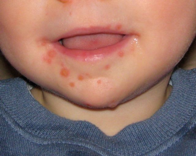 Baby lip blisters Hand foot and mouth disease
