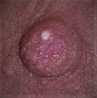 Sore Nipples caused by Nipple Blebs/Milk Blisters