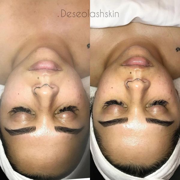 rejuvenating custom facial