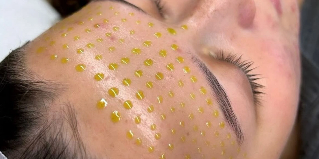 Close-up of a person with yellow dots on their forehead for a skincare treatment.