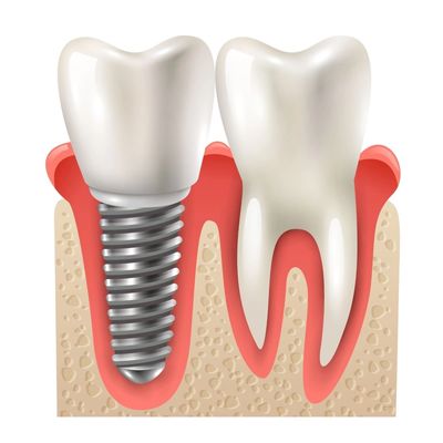 Gönen'de implant tedavisi uygulayan klinikler Gönen Diş Hekimi Hale Karlıca