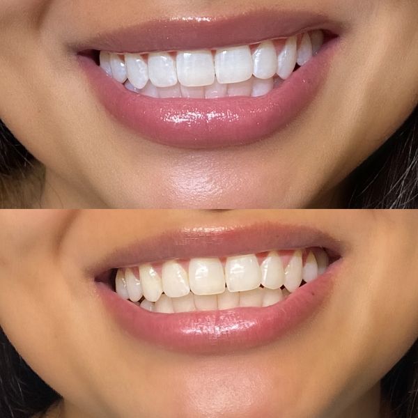 Teeth Whitening + Tooth Gem 💎 - Belle Beauty Academy