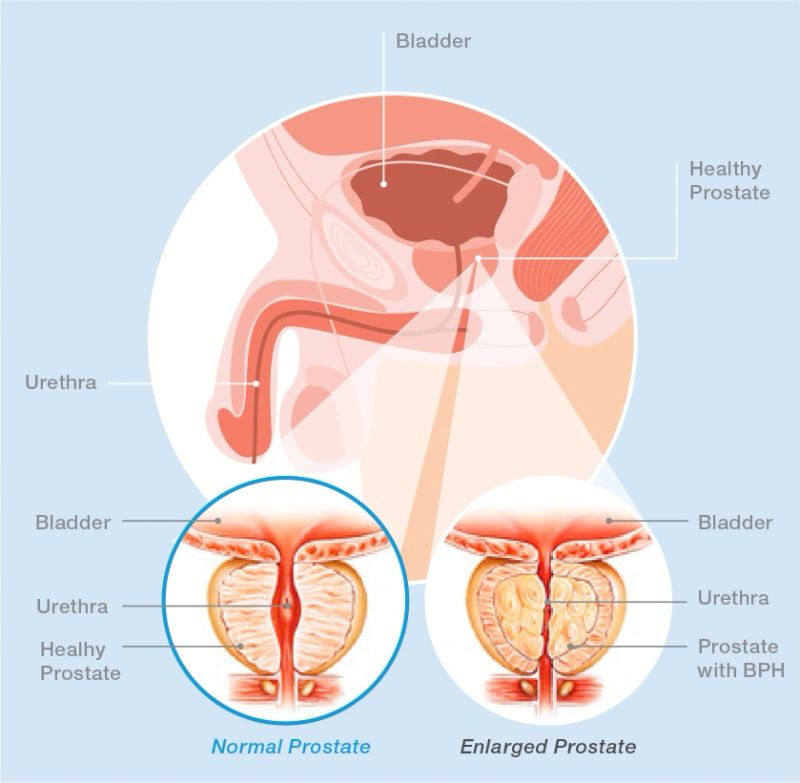 SOLTIVE-prostrate-illustration.jpg