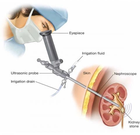 pcnl.jpg