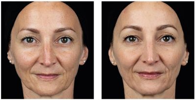 Before and After PhilArt treatment