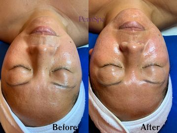 Before/after of chemical peel at PemSpa Newton – improved skin clarity, brighter & smoother texture