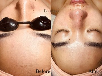 Before/after of Balanced Bliss Facial at PemSpa — reduced congestion, improved glow & smoother skin