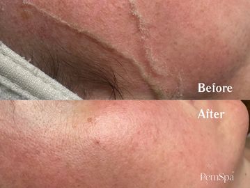 Before/after of  Dermaplane Facial at PemSpa Newton – smooth skin, peach fuzz removal & radiant glow