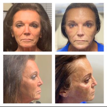 Can High Intensity Focused Ultrasound Treatment Replace Face Lift