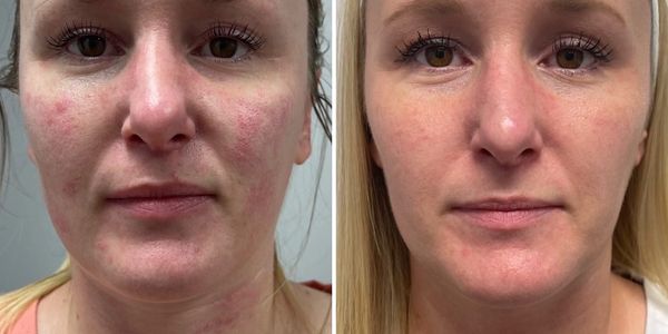 Introducing the Shallow CO₂ x2™ Non-Surgical Facelift-How a Suburban Midwest Medical Spa With a Trad