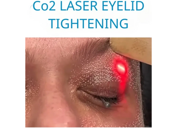 CO2 laser eyelid tightening is a cosmetic procedure that uses a CO2 laser to minimize excess skin