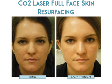 Co2 Full Face Laser ResurfacingThese days you wont see a celebrity $150,000 Deep Plane Face Lift tha