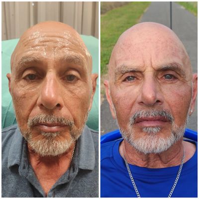 semaglutide hair growth Does Semaglutide Cause Hair Loss? (Ozempic & Wegovy Explained)