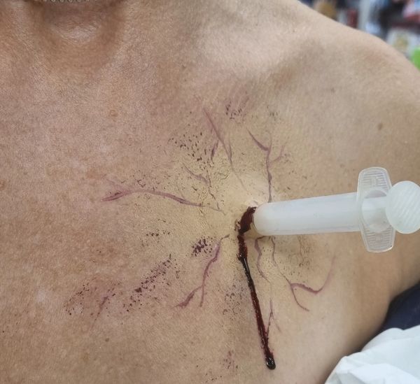 SFX Syringe in chest