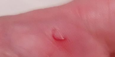 Close-up of a healing wound on skin.