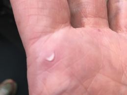 Close-up of a hand with a blister.