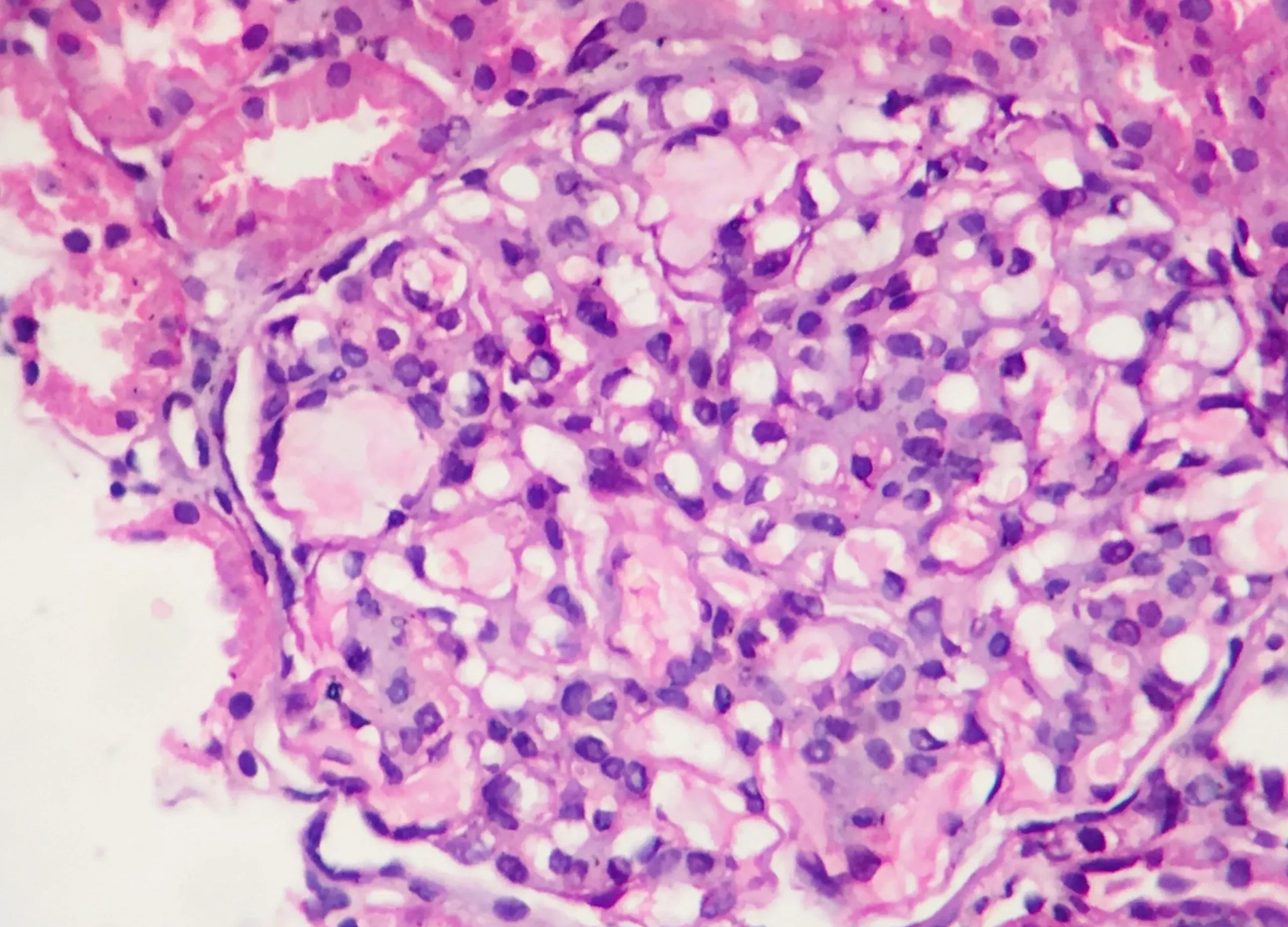 Archives indian society of renal transplantation pathology isrtp 