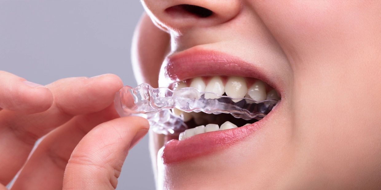 patient putting in their angel aligners 