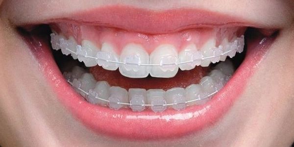 Dr Akhil Agarwal MDS (KGMU)- Dentist Smile Orthodontist in Lucknow Dental Ceramic Braces Aligners