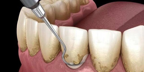 Teeth Cleaning & Polishing in Lucknow
Dr Akhil Agarwal MDS (KGMU) Dentist Orthodontist Dental Clinic
