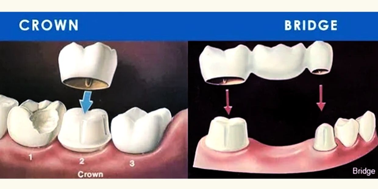 Dental Crown and Bridge of teeth in Lucknow