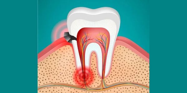 Root Canal Treatment RCT in Lucknow