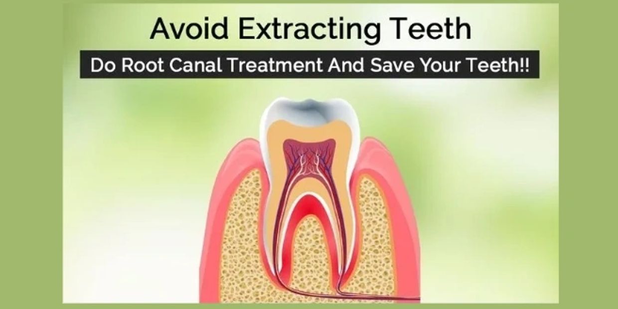 Root Canal Treatment RCT in Lucknow