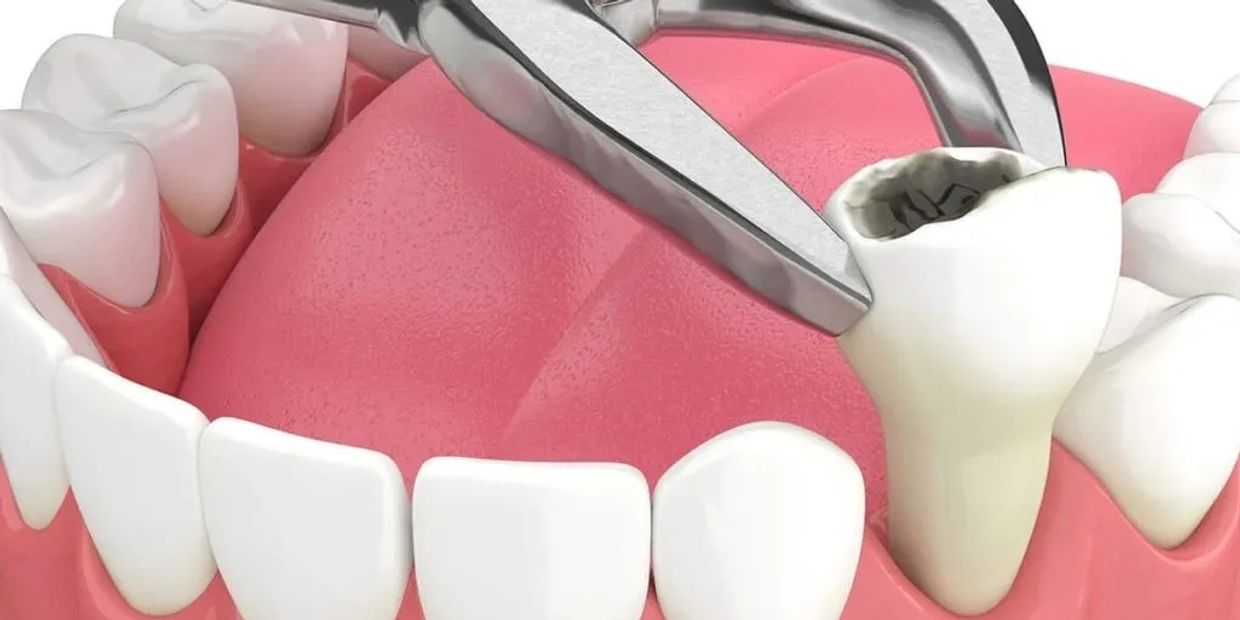 Dental extraction or tooth removal