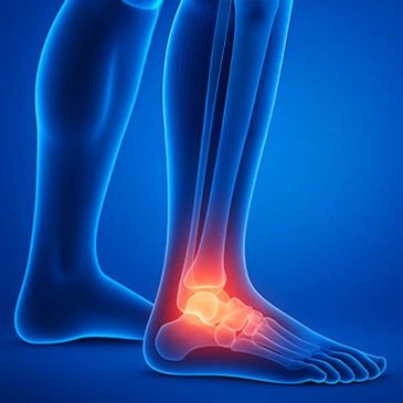 X-ray showing ankle joint inflammation.