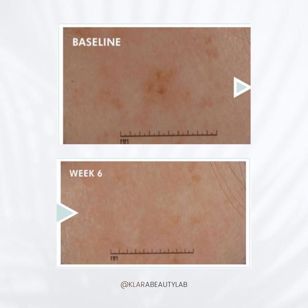 Skin improvement shown from baseline to week 6 with reduced dark spots.
