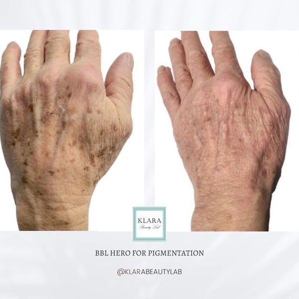 Before and after images showing reduced pigmentation on an aging hand.