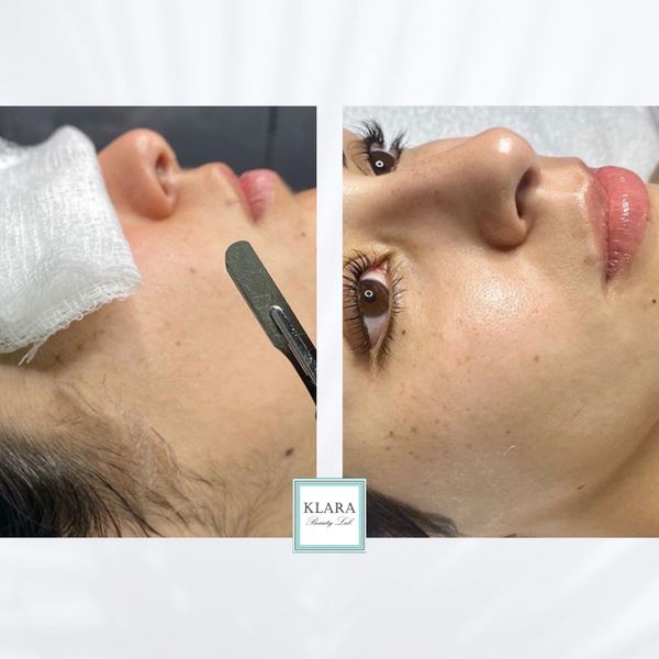 Before and after facial dermaplaning treatment showing smoother skin.