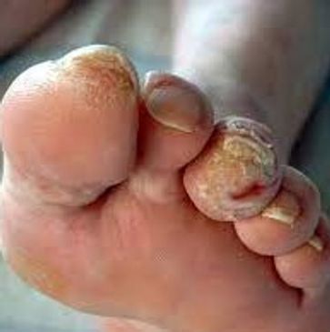 Diabetic Foot Care
