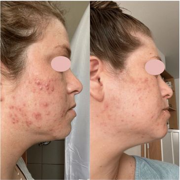 Cold Plasma - Acne Treatments