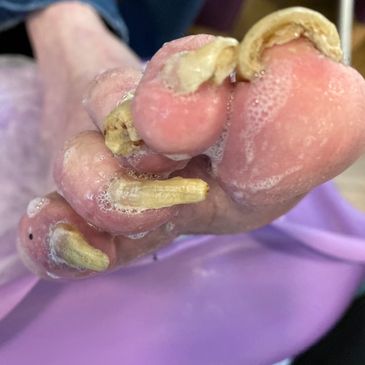 Thick Nail correction