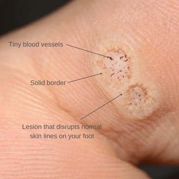 Verruca treatment
