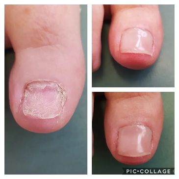 Toe Nail Reconstruction