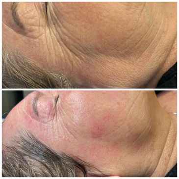 Carboxy Therapy  Facial