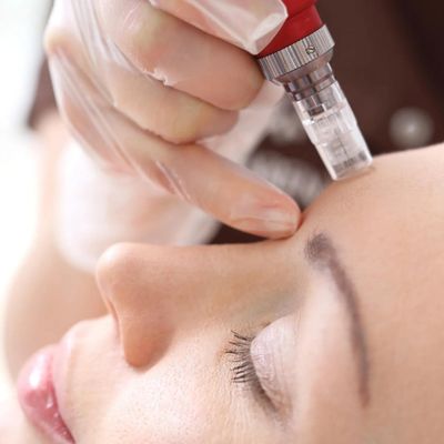 microneedling needling medicale con dermapen o dermaroller per cura pelle, acne, cicatrici, macchie