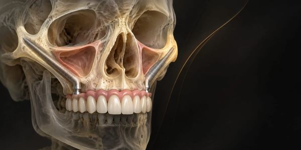 3D rendering of a skull with dental implants and sinuses visible.