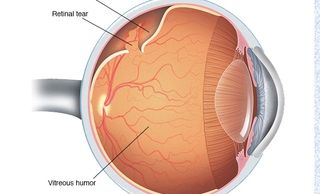 Retinal detachment diagram