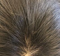 Silk base hair loss systems London 