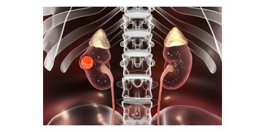 Kidneys can have tumors some benign called angiomyolipomas and others malignant or cancerous 